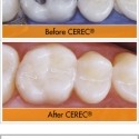 cerec-before-after-1